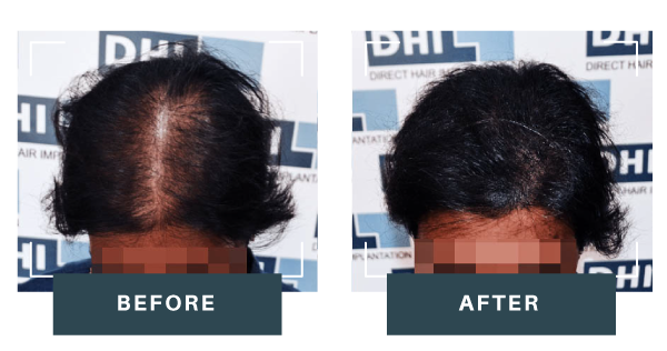 Female-Hair-Transplant-2.0-result-2