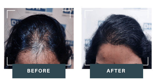 Female-Hair-Transplant-2.0-result-4