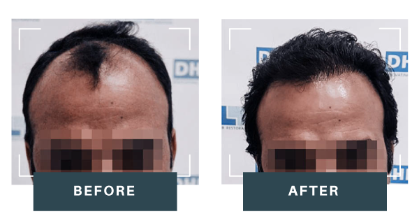 Male-Hair-Transplant-2.0-result-1