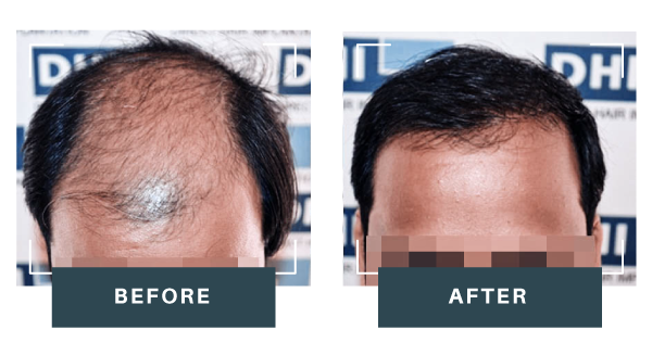 Male-Hair-Transplant-2.0-result-2