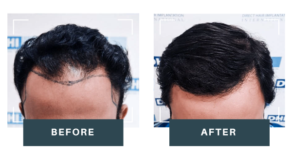 Male-Hair-Transplant-2.0-result-3